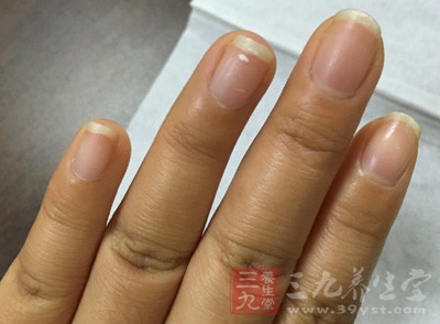 指甲过长，经常容易刮到，受伤